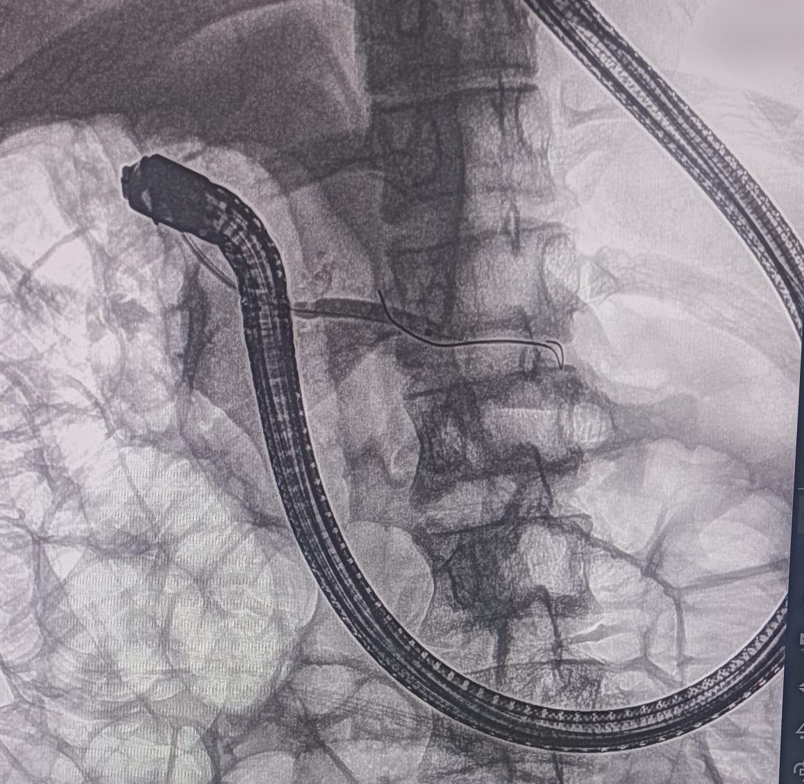 Chronic Pancreatitis ERCP Image 2